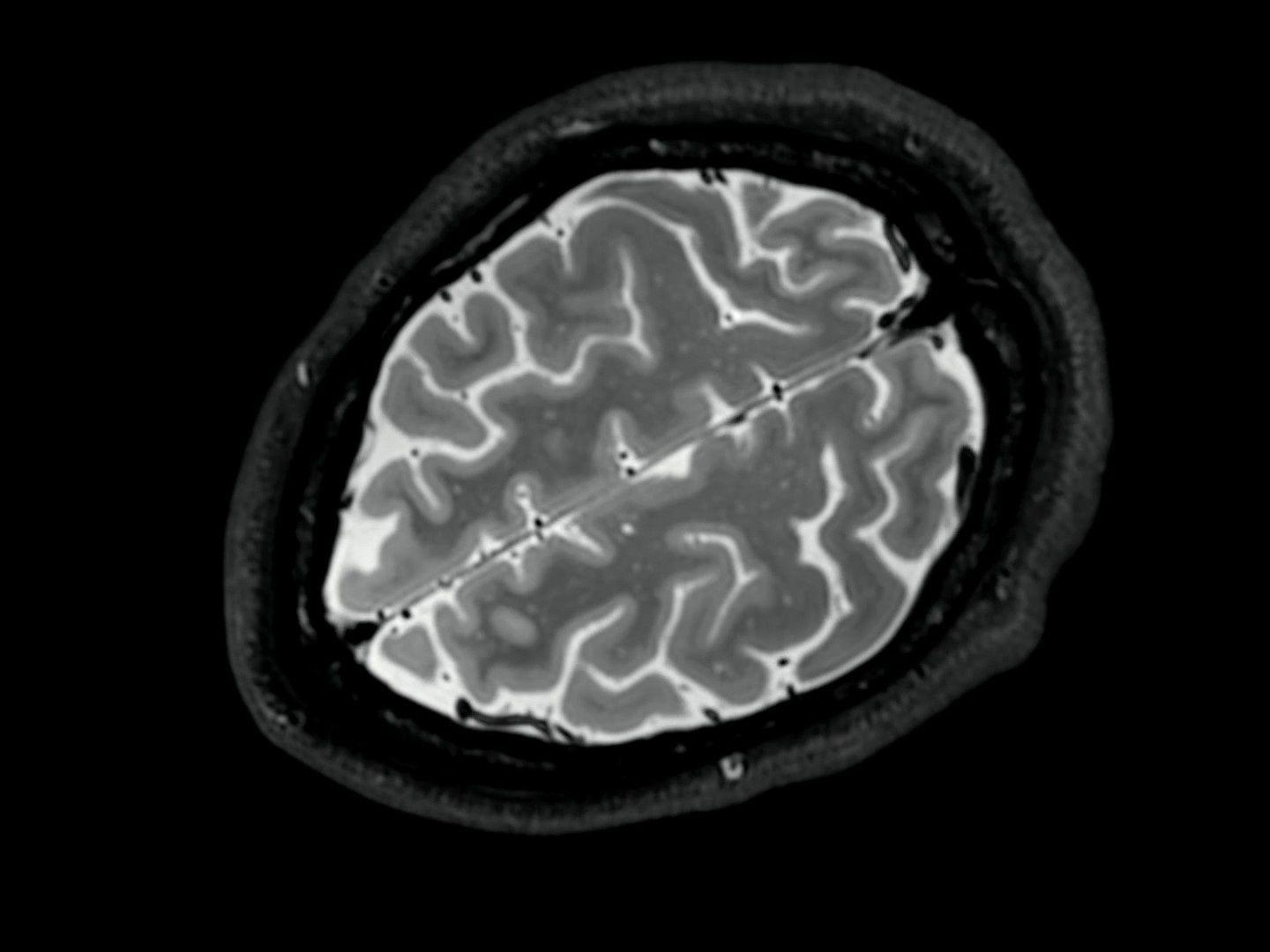 a mri image of a brain in black and white