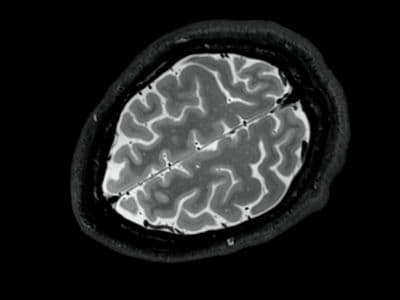 a mri image of a brain in black and white